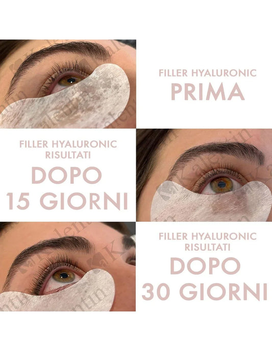 KALENTIN BOTOX HYALURONIC - Lady&Oscar